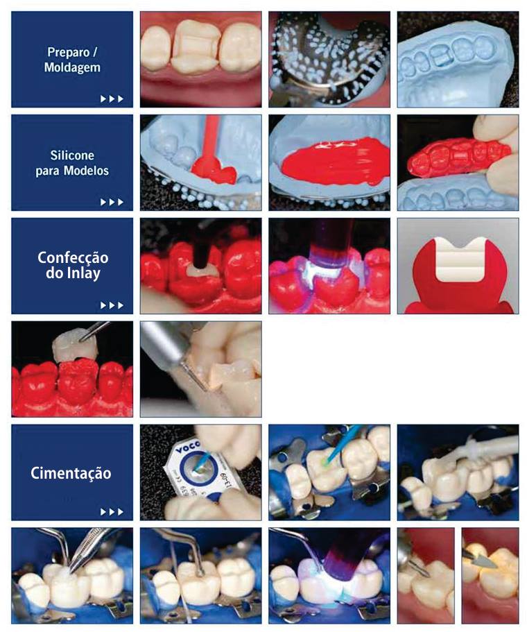 Inlay e Onlay em uma sessão