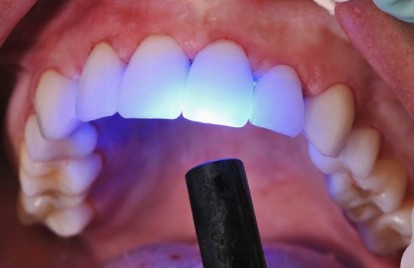 No momento você está vendo Lentes Diretas na Odontologia – Opção ao Dentista
