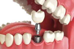Read more about the article 9 Marcas de Implantes Dentários usadas na Odontologia do Brasil