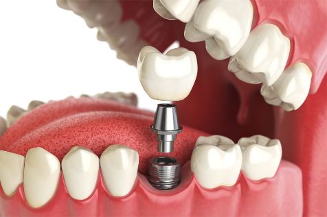 No momento você está vendo 9 Marcas de Implantes Dentários usadas na Odontologia do Brasil
