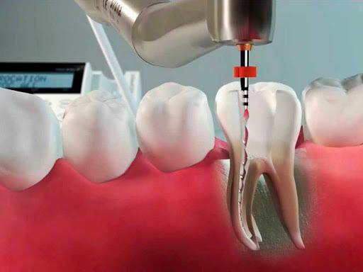 Curso de Endodontia Mecanizada