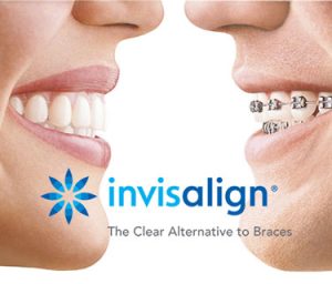 Leia mais sobre o artigo Invisalign – Conheça o tratamento, aparelhos e vantagens!