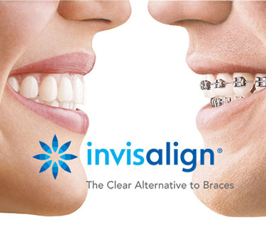 o que é Invisalign®? Conheça as 12 vantagens do tratamento