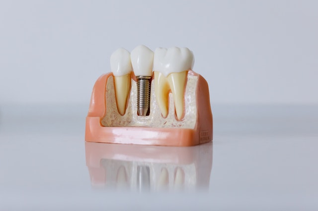 No momento você está vendo Implantes Dentários: Vantagens, procedimentos, soluções, riscos e cuidados posteriores