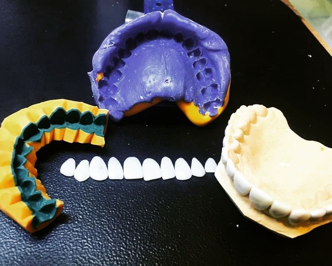 No momento, você está visualizando Mock Up nas Lentes Dentais – Do Planejamento à Perfeição e Seu Papel na Estética Dental